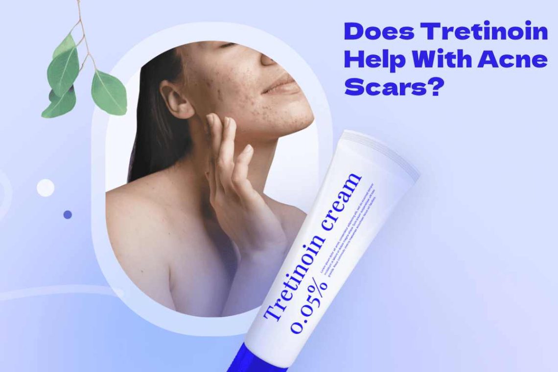 Tretinoin Help With Acne Scars