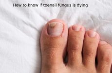 How to know if toenail fungus is dying