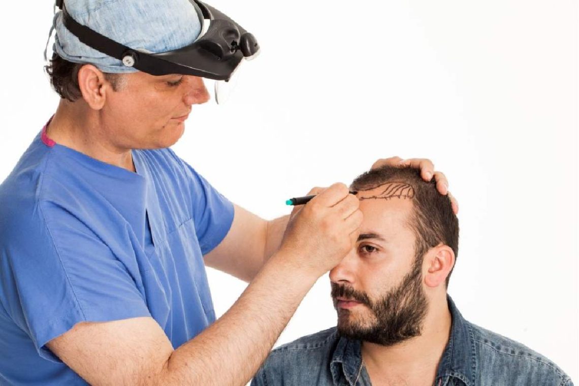 cost of hair transplant in india